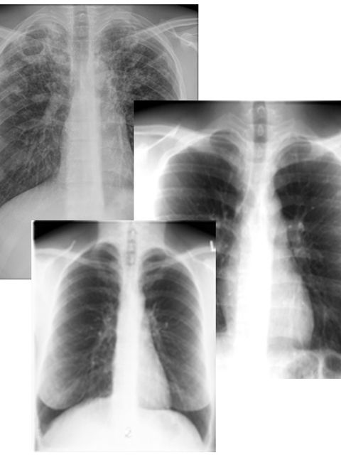 Röntgenbild Tuberkulose
