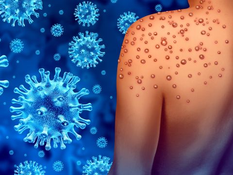Monkeypox Infections Outbreak