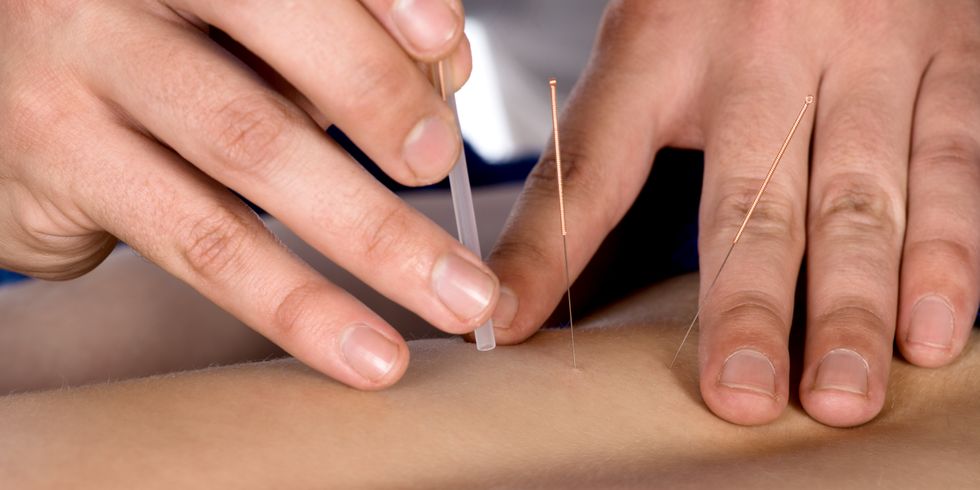 Ein Physiotherapeut behandelt einen Patienten mit Akupunktur